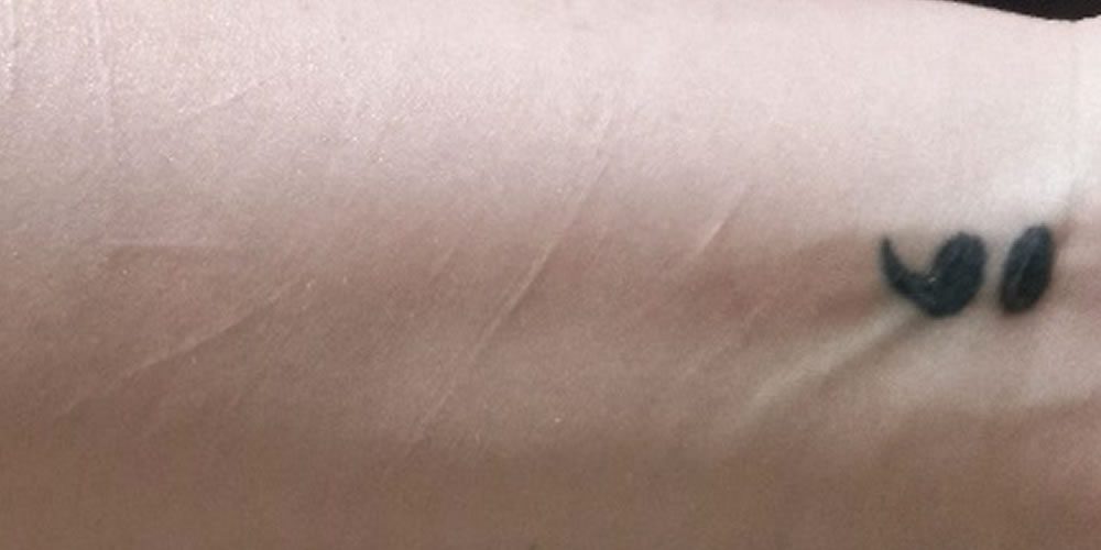 SCAR